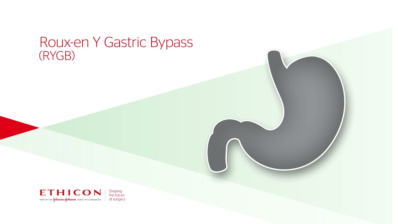 Roux-en-Y Gastric Bypass Animation