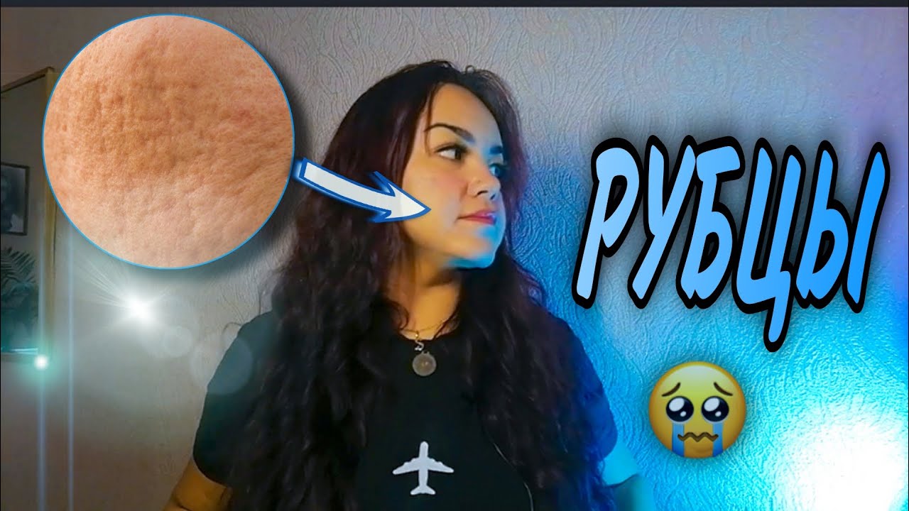 Как УБРАТЬ РУБЦЫ БЕЗ ЛАЗЕРНОЙ ШЛИФОВКИ! Действенные способы.Все разновидности рубцов💉🩹