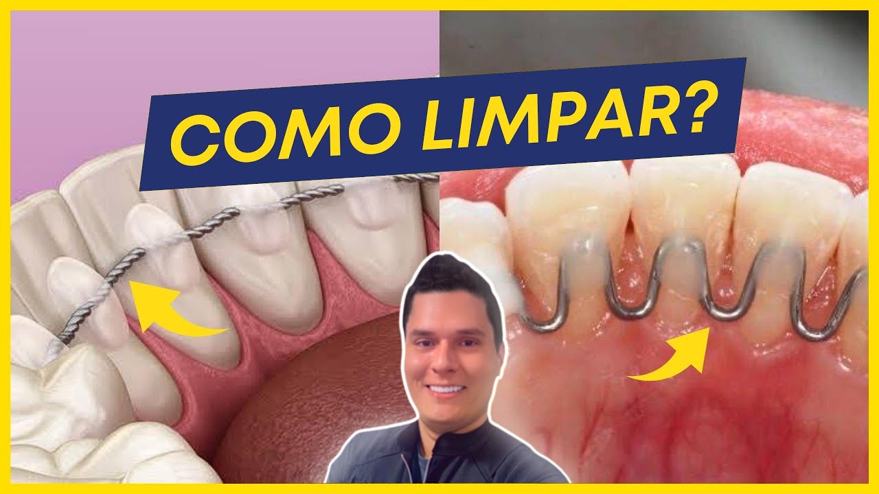 COMO HIGIENIZAR A CONTENÇÃO ORTODÔNTICA FIXA? GUIA PRÁTICO!