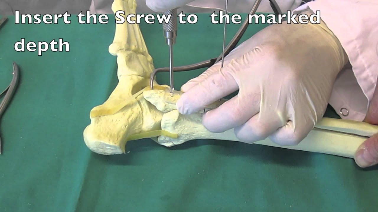 Inion FreedomPlate&trade; - Ankle Fixation