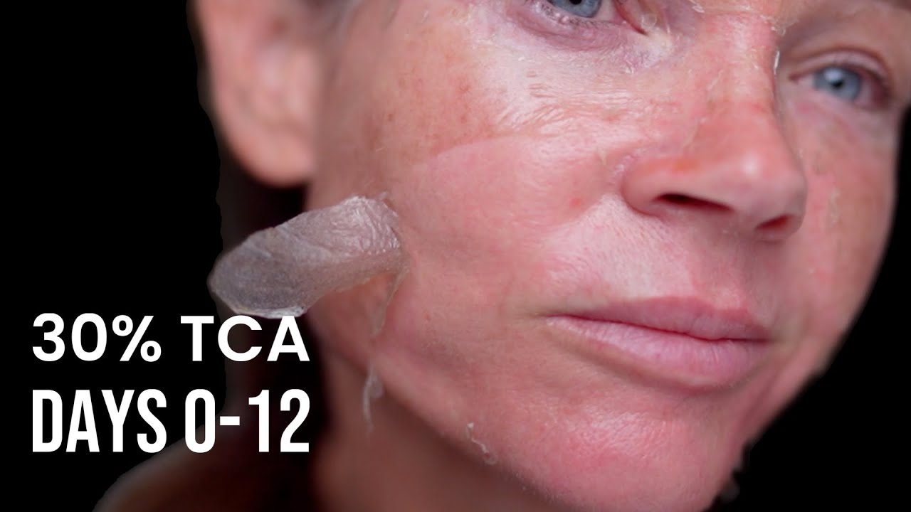 30 TCA Peel Full Demo | Real Time Application & Layering Process