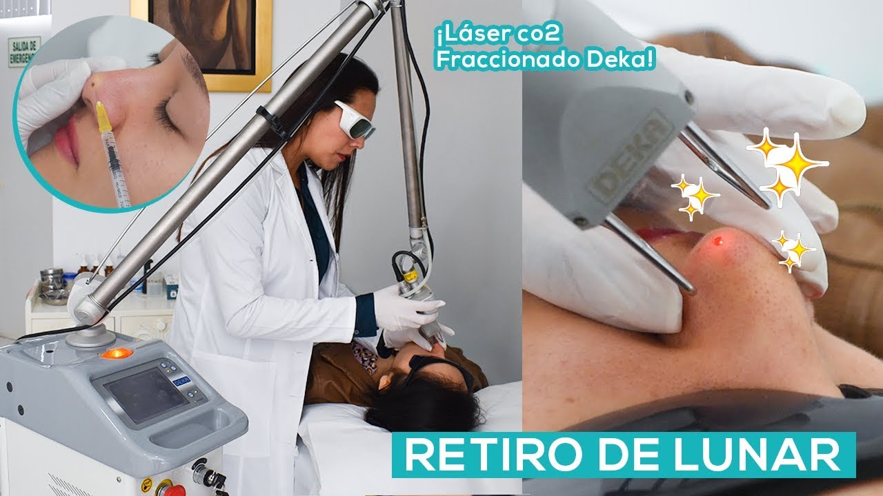 Retiro de Lunar con Laser CO2 Fraccionado DEKA ‼️😱- Clinica de la Belleza - Trujillo Peru