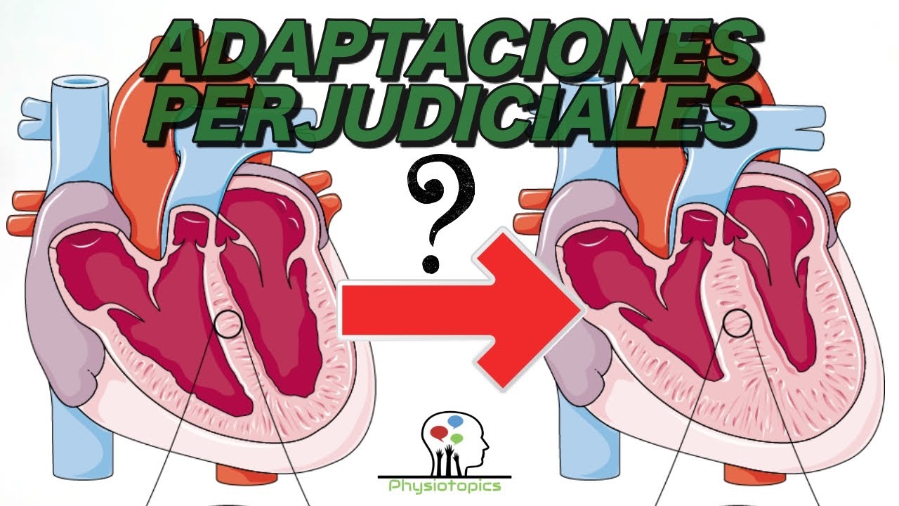 Hipertrofia Cardíaca: 