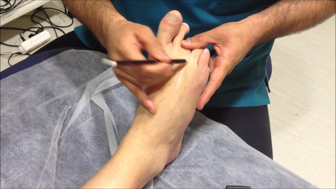 Neuroma de Morton