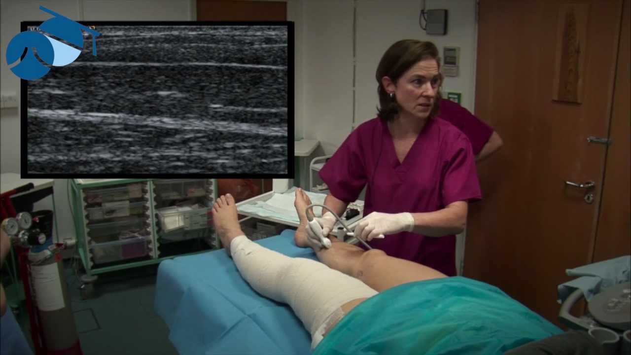Marking feeding veins for foam sclerotherapy