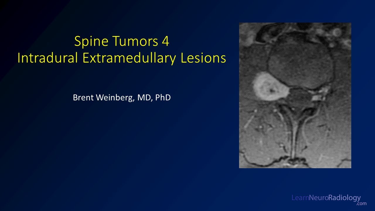 Spine tumors 4 – Intradural Extramedullary Lesions