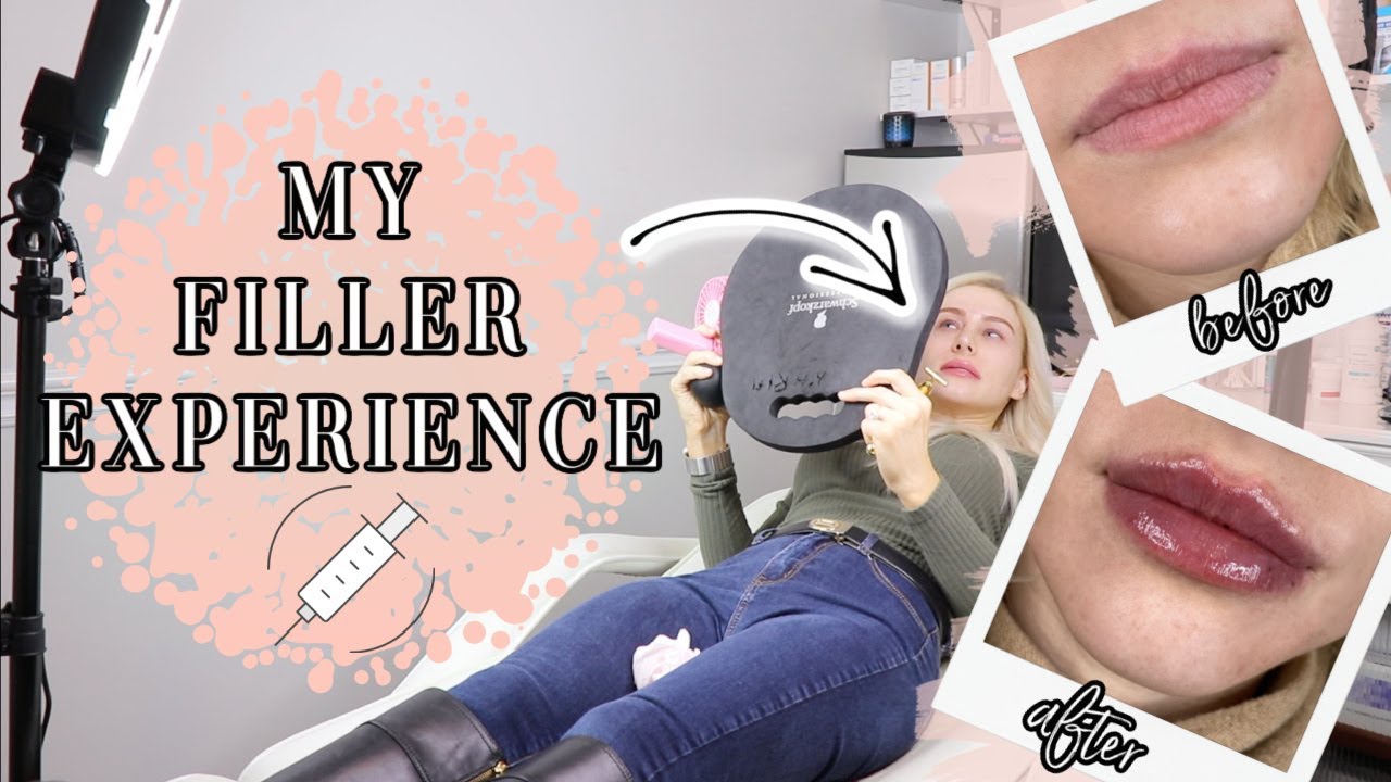 MY FILLER EXPERIENCE&hellip;WHAT YOU NEED TO KNOW BEFORE!