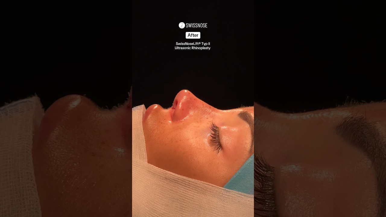 Barbie nose before and after | Dr. med. Simon Zimmermann