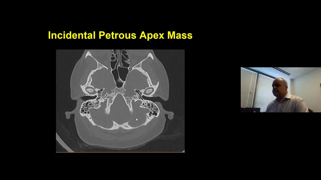 Challenging Otology Cases