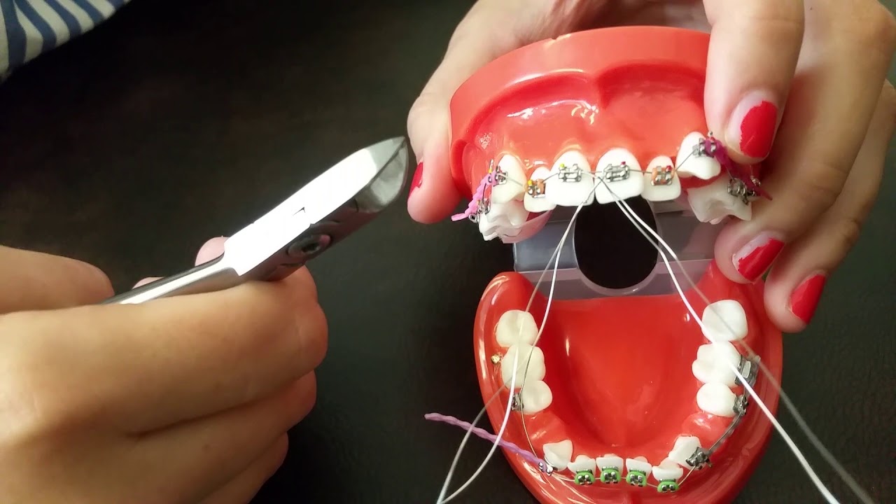 Placing a stainless steel ligature wire for Braces