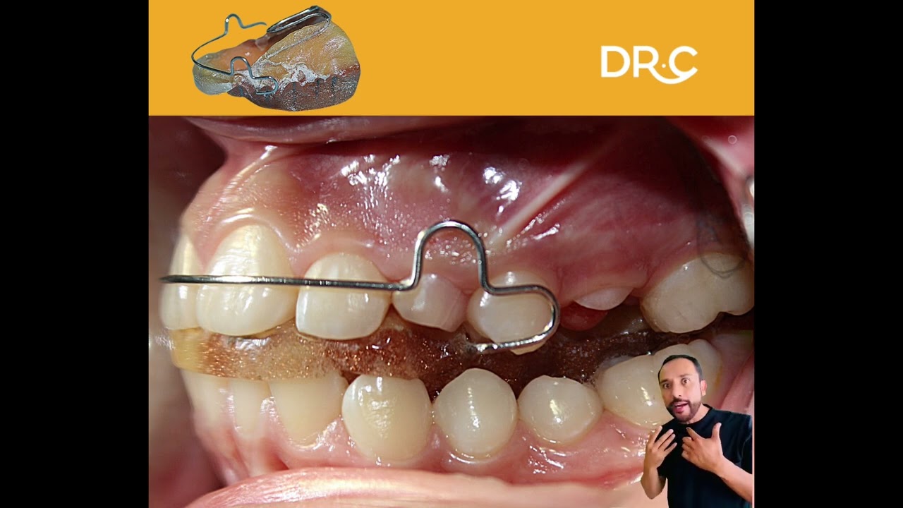Este es un caso real de Ortopedia Dental.