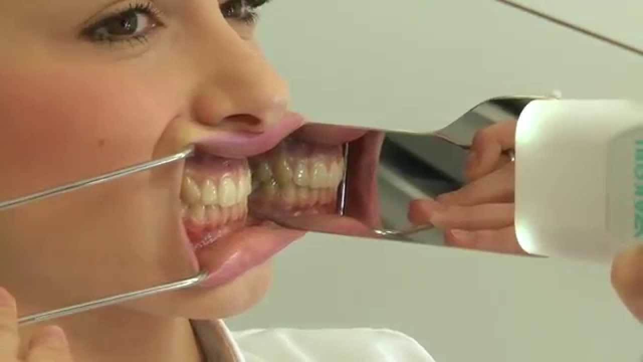 Photo Mirror Demister (english) - Jakobi Dental GmbH