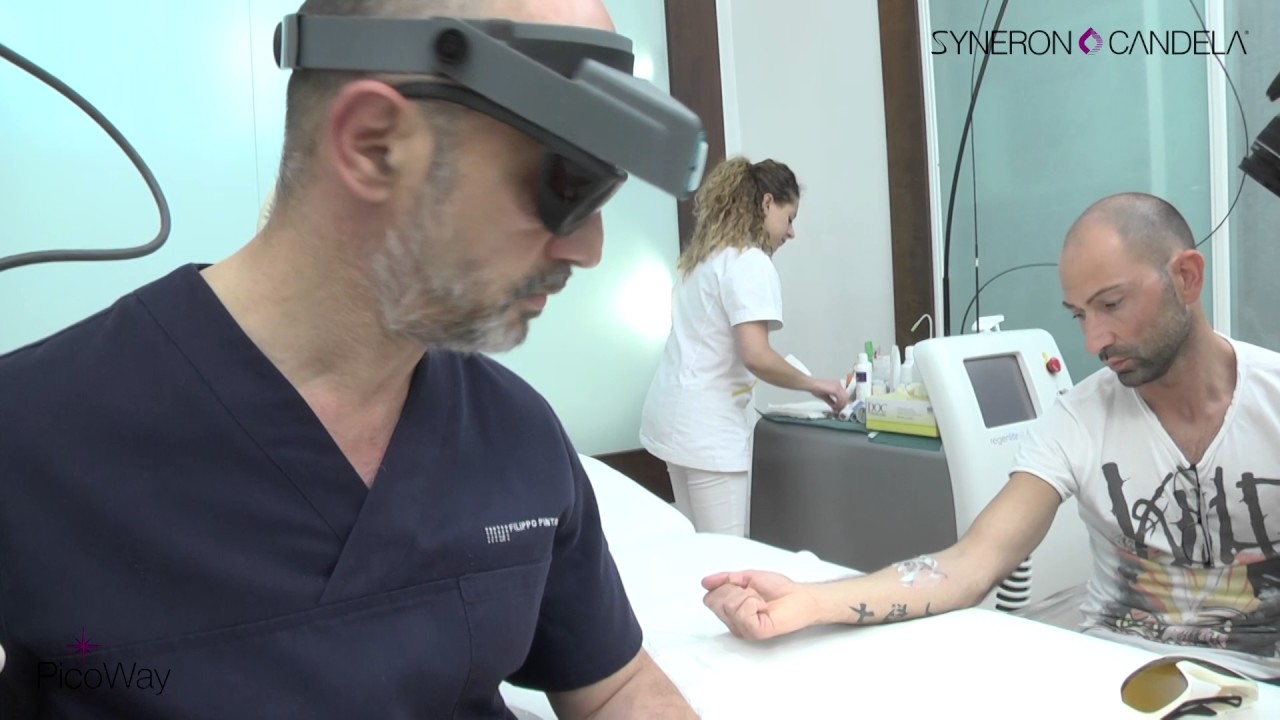 Rimozione tatuaggi_PICOWAY_Syneron Candela_ Dott. Filippo Pinto