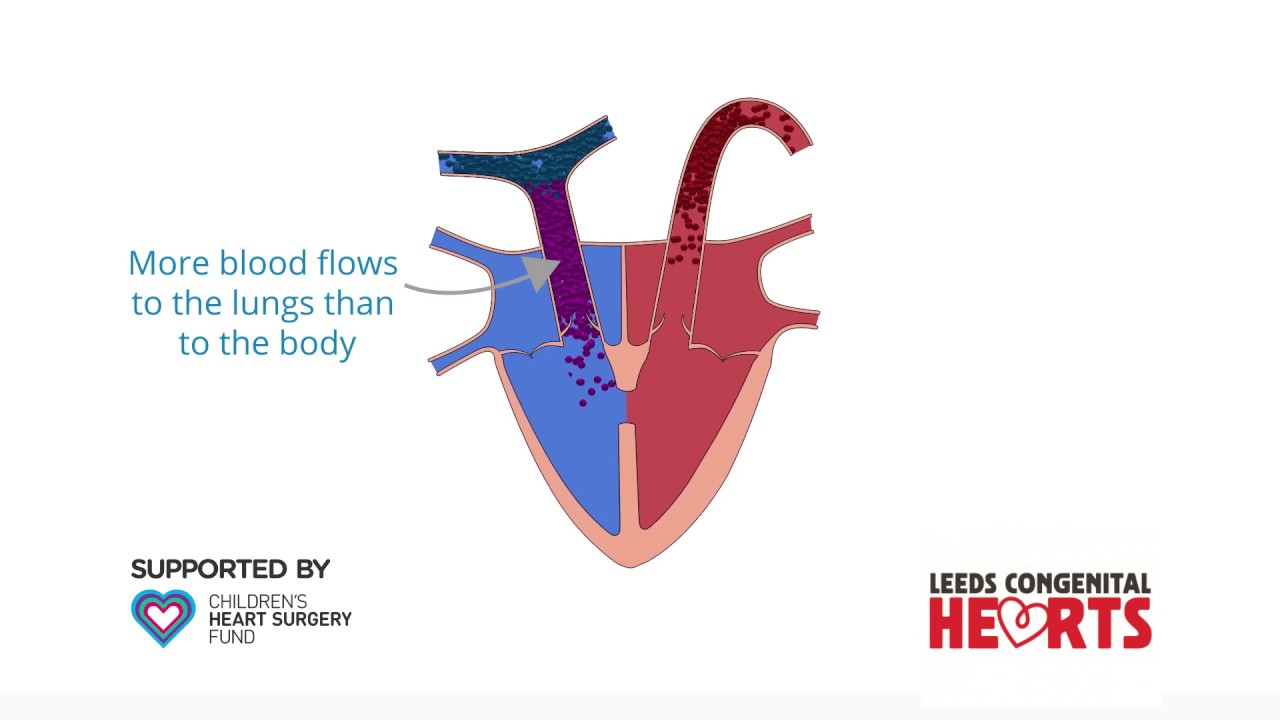 Ventricular Septal Defect