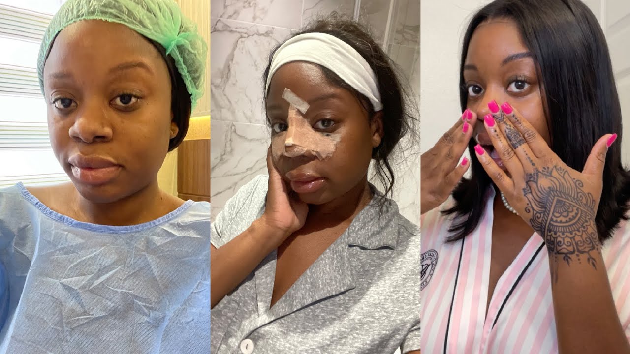 MY ETHNIC RHINOPLASTY REVEAL! (SHOCKING) + MY HONEST EXPERIENCE + 2 MONTH UPDATE