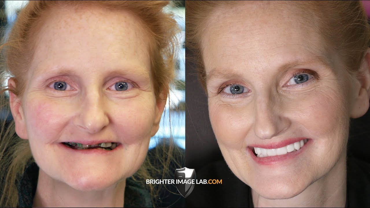 День матери Улыбка Makeover Чудо-стоматологические виниры для свадьбы дочери