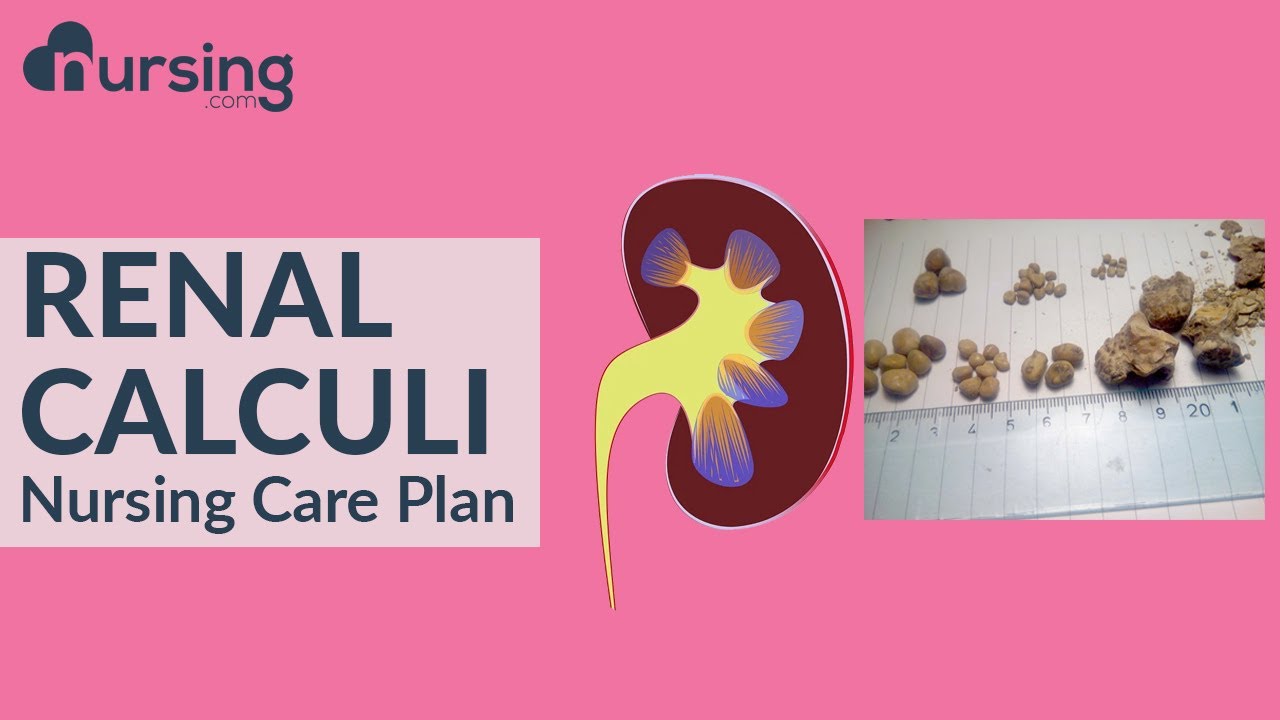 Nursing Care Plan for Renal Calculi (Nursing Care Plan Tutorial)