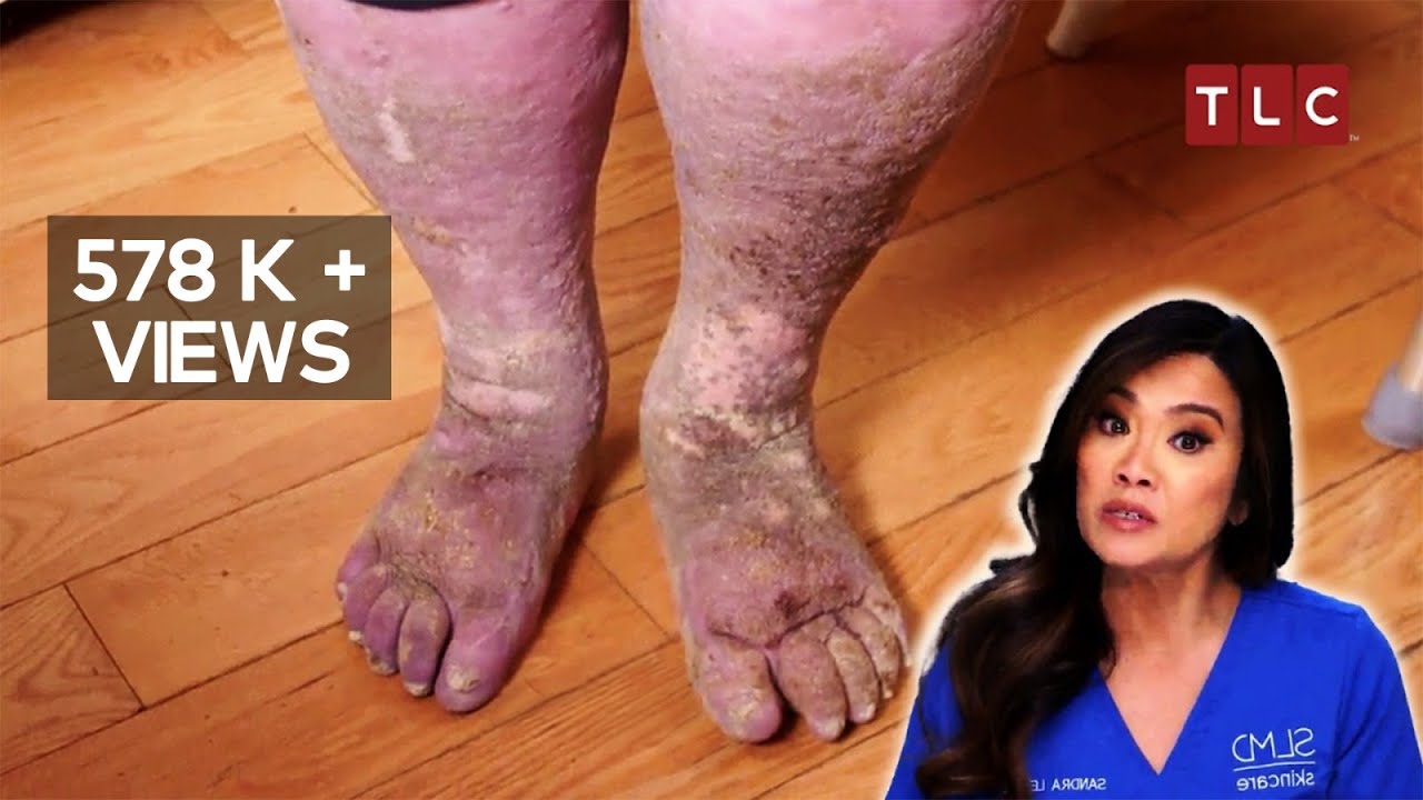 Sandra&rsquo;s Fight Between Life and Death! | Dr Pimple Popper | TLC