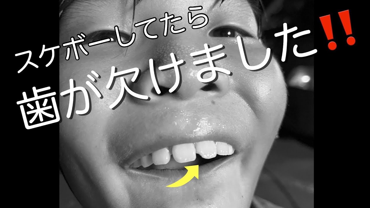 #13~ スポーツマウスガード(マウスピース)編~