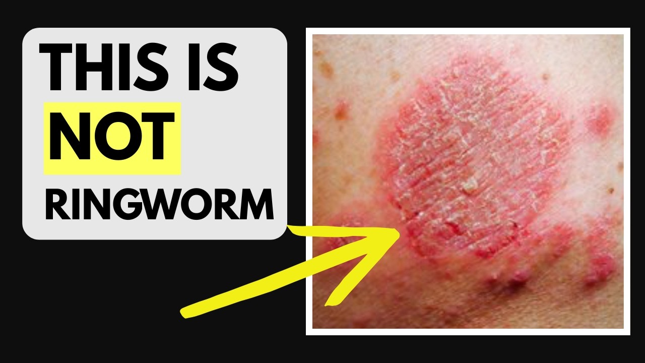 Doctor explains Discoid Eczema | Causes, Symptoms, Photos and Treatment