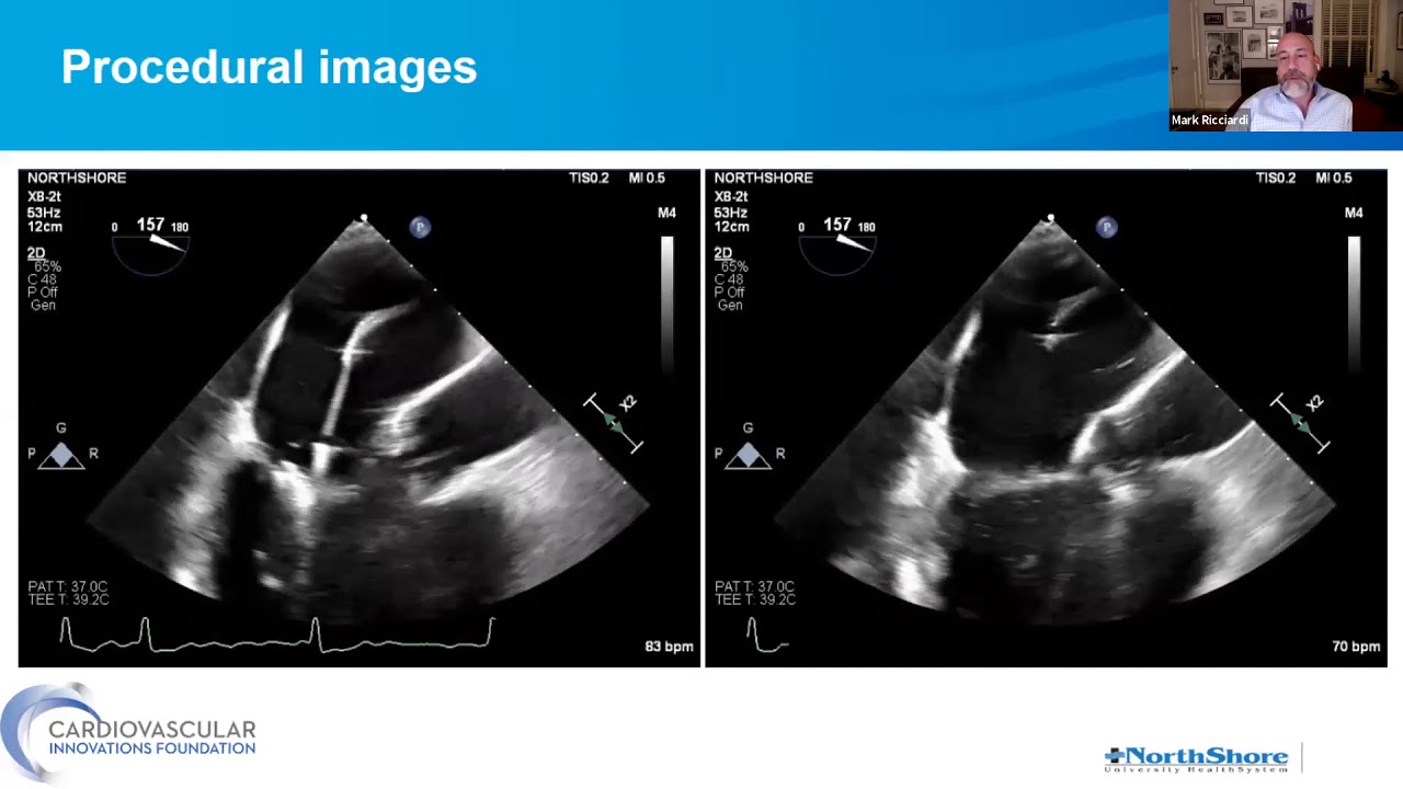 CVI - Transcatheter Mitral Innovations