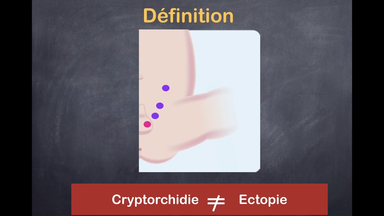 Pathologies génitaux-scrotales - 4. Cryptorchidie