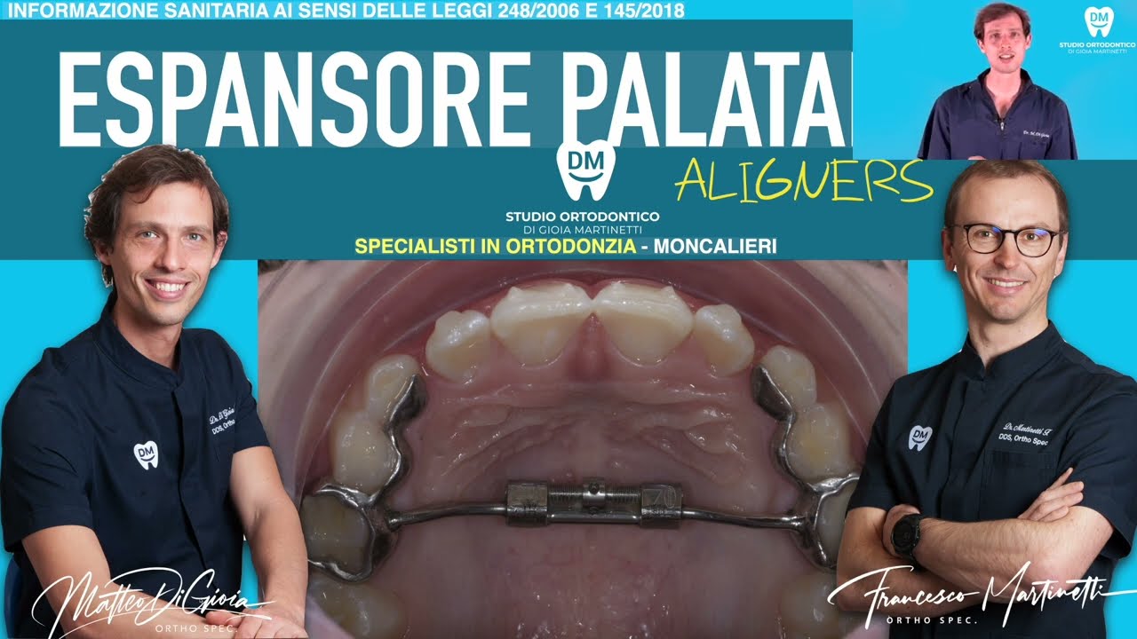 Palato Stretto: Espansore e Allineatori nel bambino: per far uscire tutti i denti e metterli dritti!
