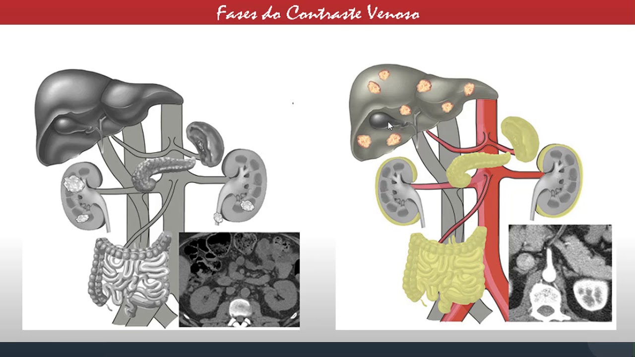 Fases do Contraste Venoso |Parte 01
