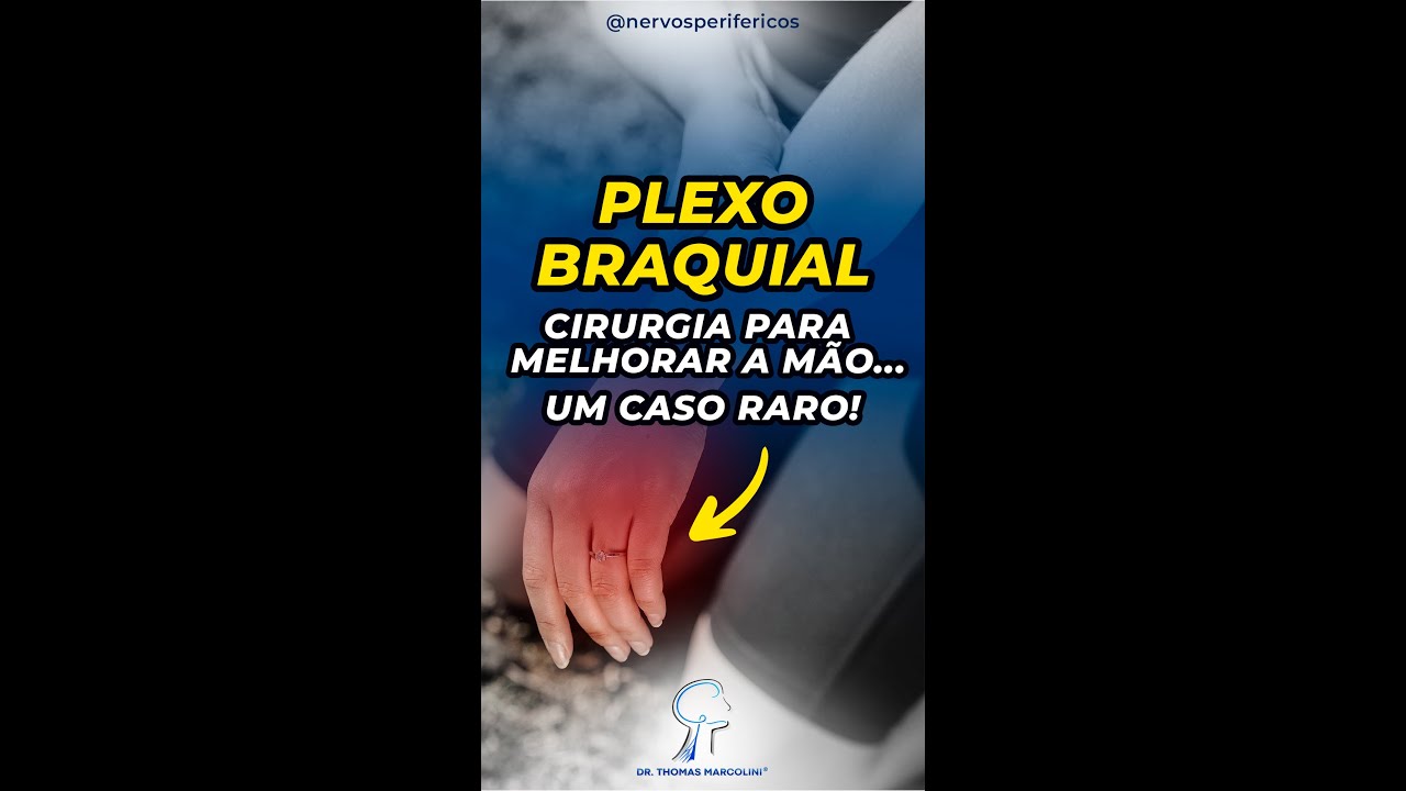 Recuperação da Mão Após Lesão do Plexo Braquial, Lesão C8-T1!