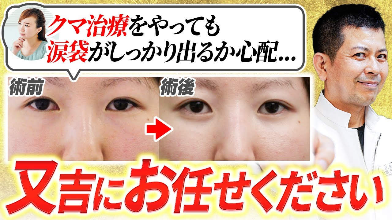 涙袋にヒアルロン酸は悪手！？クマ治療をしたら涙袋がしっかり出てくるのか心配な方は必ず見てください。