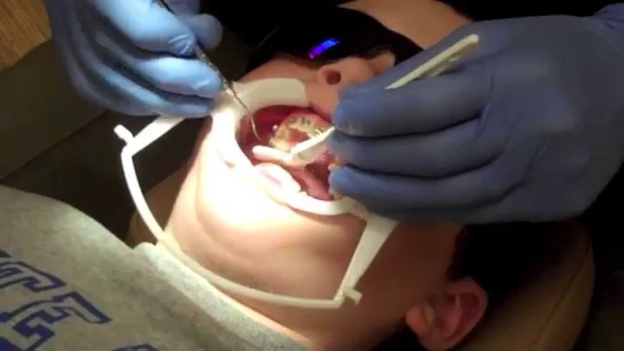 Brett Getting Braces