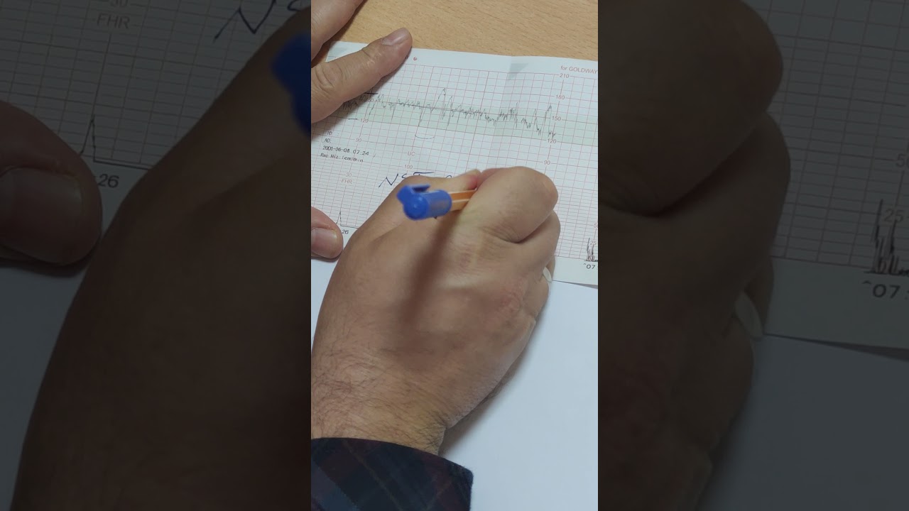 NST (NON-STRESS TEST) YORUMLANMASİ