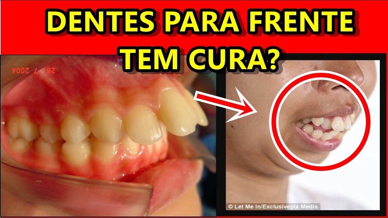Dentes Muito Para Frente? Como Corrigir?