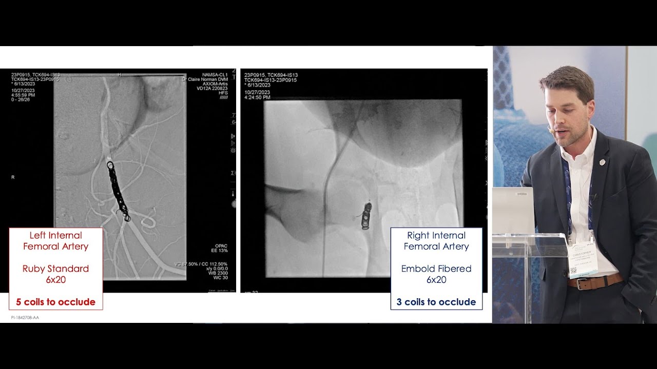 EMBOLD™ Detachable Coil System: Pre-Clinical Embolic Comparative Study