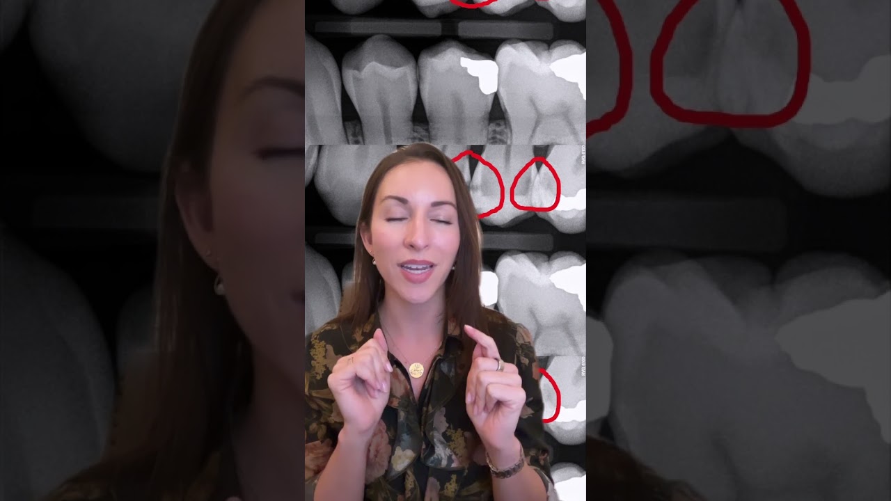 How Do You Heal a Cavity?
