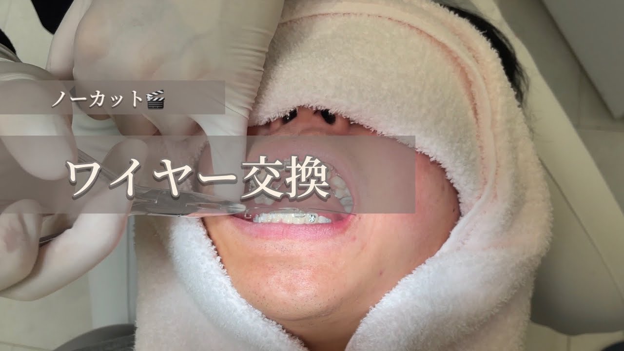 【ブラケット矯正🦷】ワイヤーの交換　ノーカット🎬
