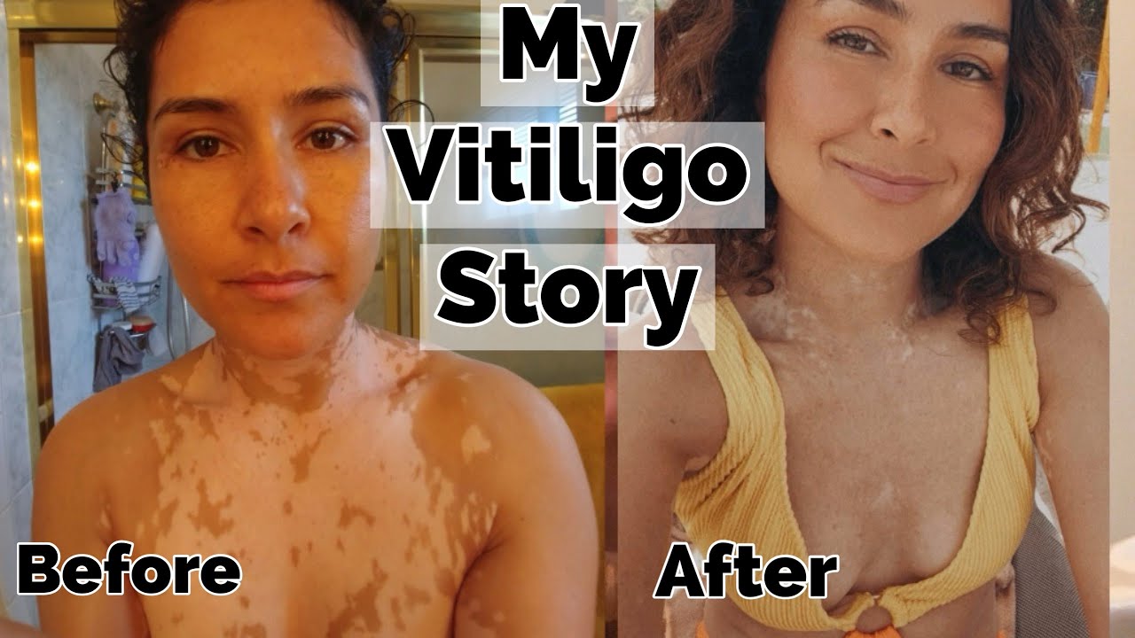 My Vitiligo Story- How I regained 70% of my pigment