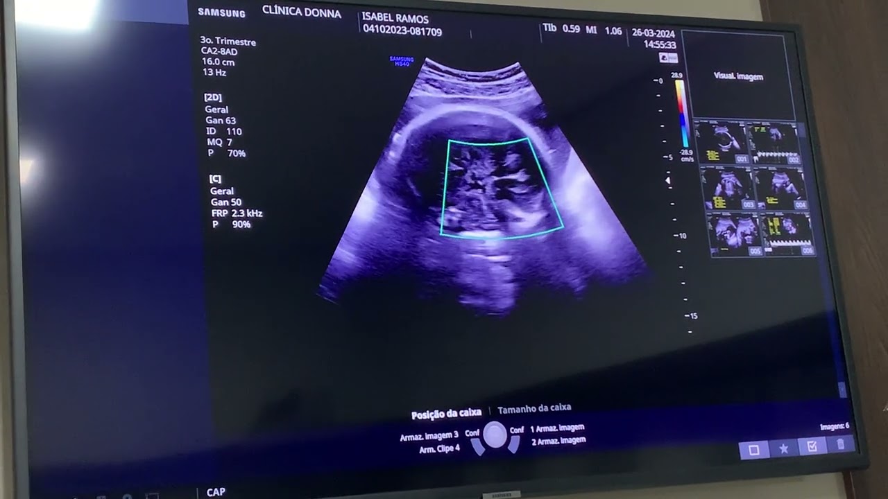 Ultrassom João Gabriel 28 semanas