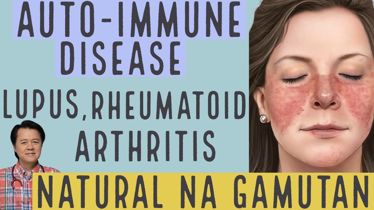 Auto-immune Disease: Lupus, Rheumatoid Arthritis. Natural na Gamutan - Payo ni Doc Willie Ong #1169