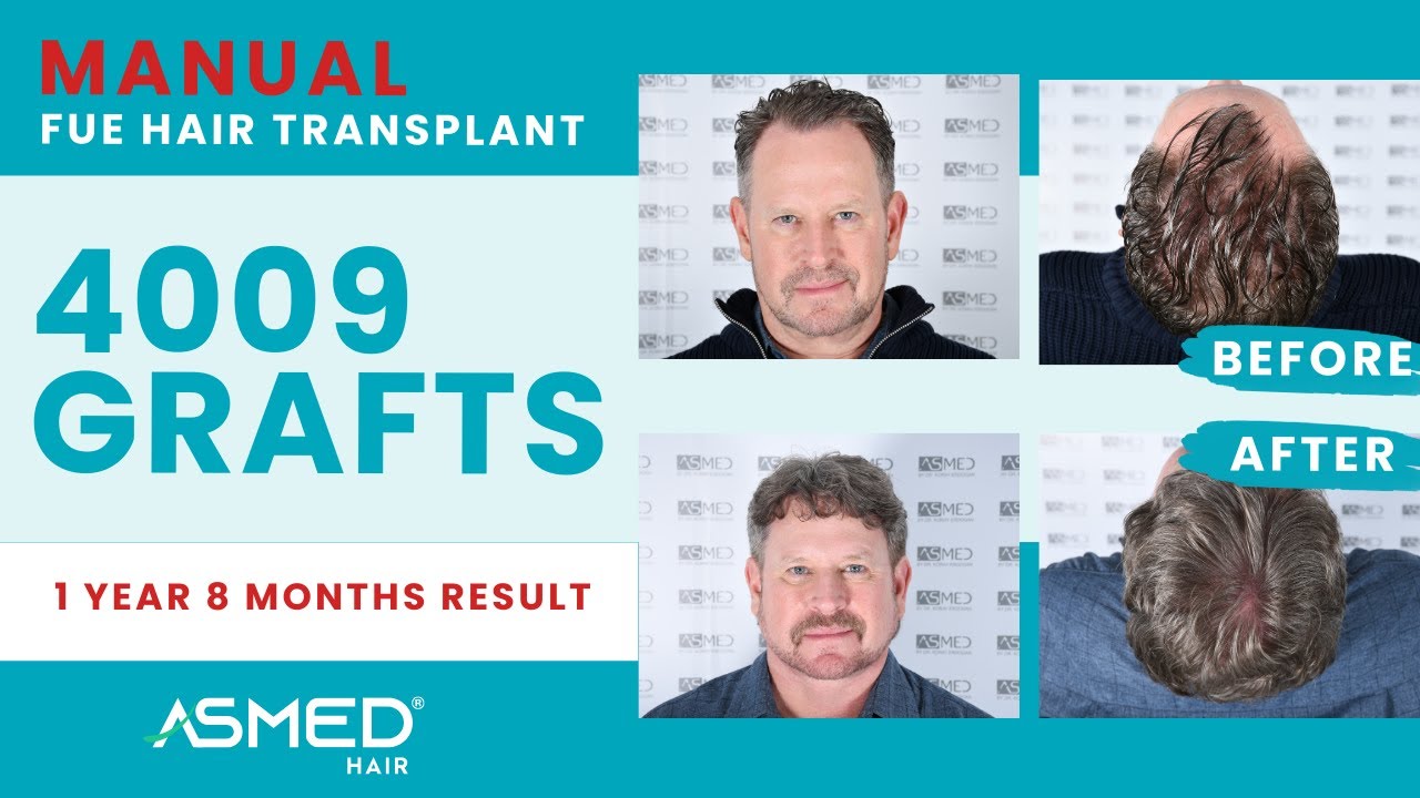 ASMED – Dr. Koray Erdogan – 4009 Grafts | 1 Year 8 Months Results