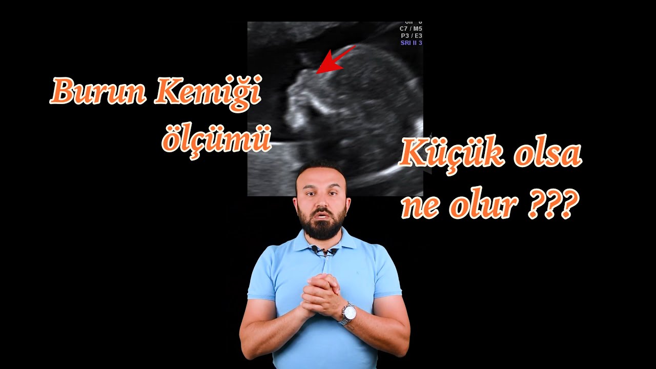 Detaylı Ultrasonda Burun Kemiği Ölçümü I Doç. Dr. Ali Ekiz