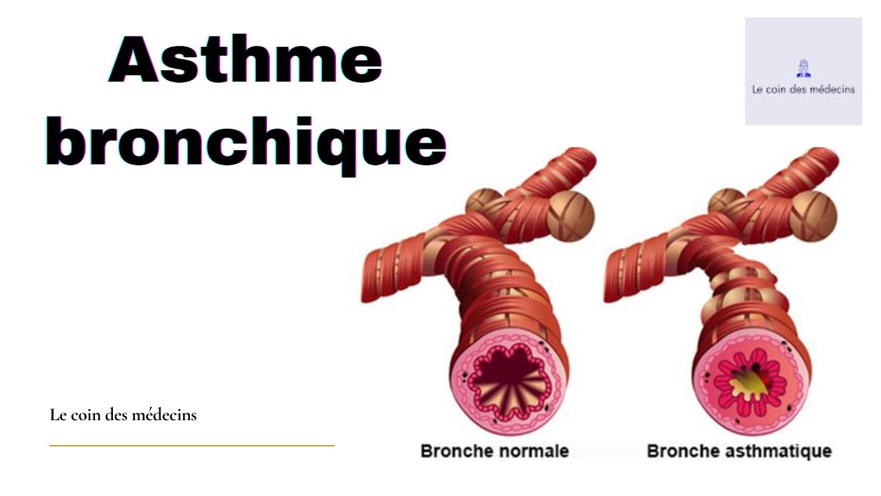Asthme bronchique