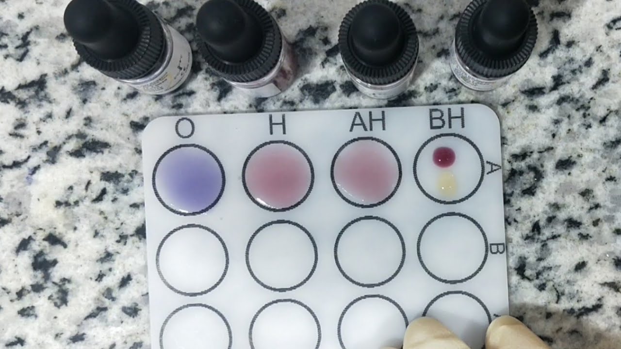 شرح كيفية عمل تحليل الفيدال Widal Test عملي.