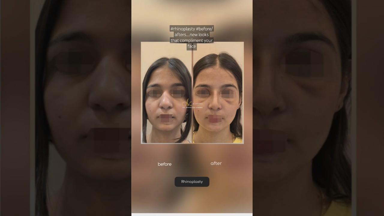 #rhinoplasty Surgeon in Jaipur | get the best shape of your nose. Rhinoplasty surgery before/ afters