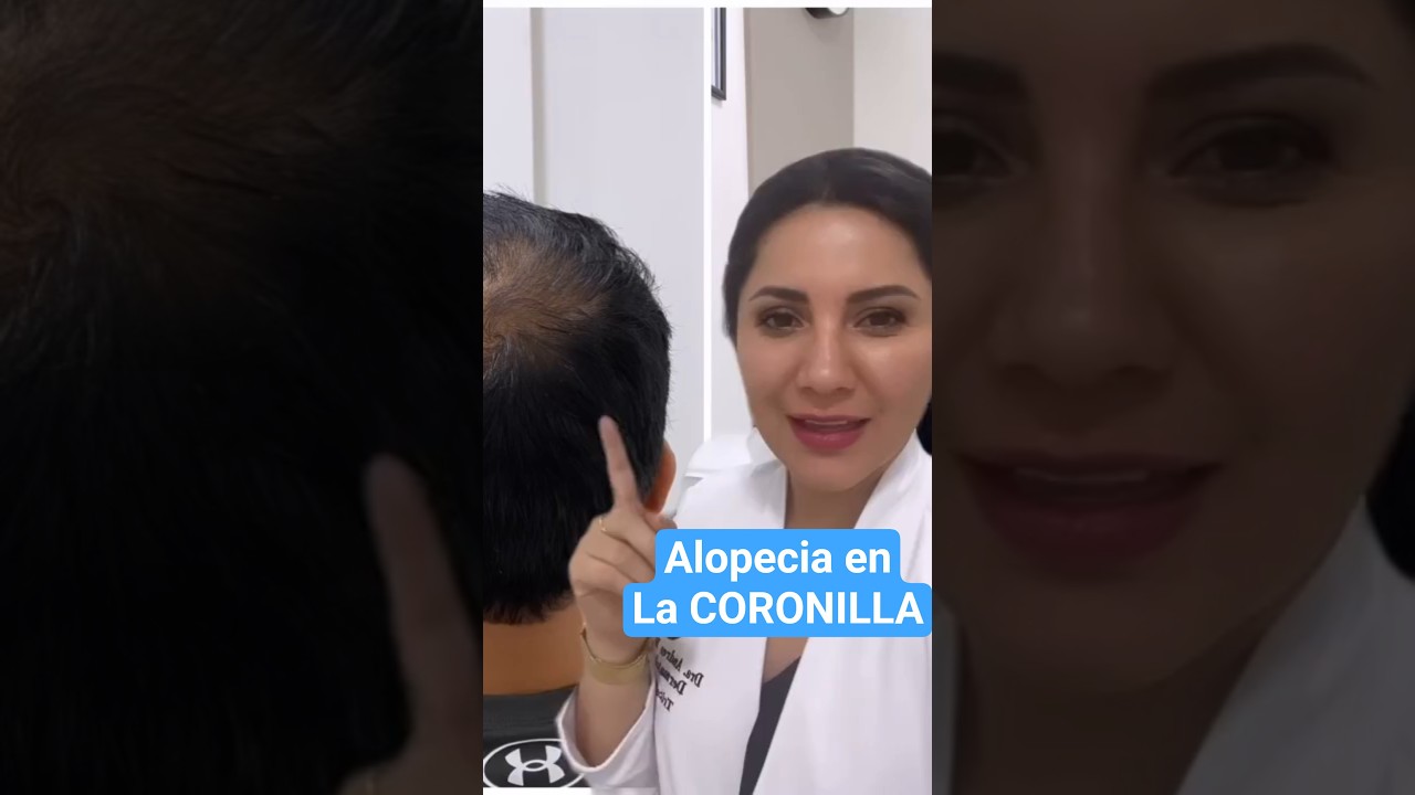 Alopecia en la Coronilla de la cabeza - #Calvicie
