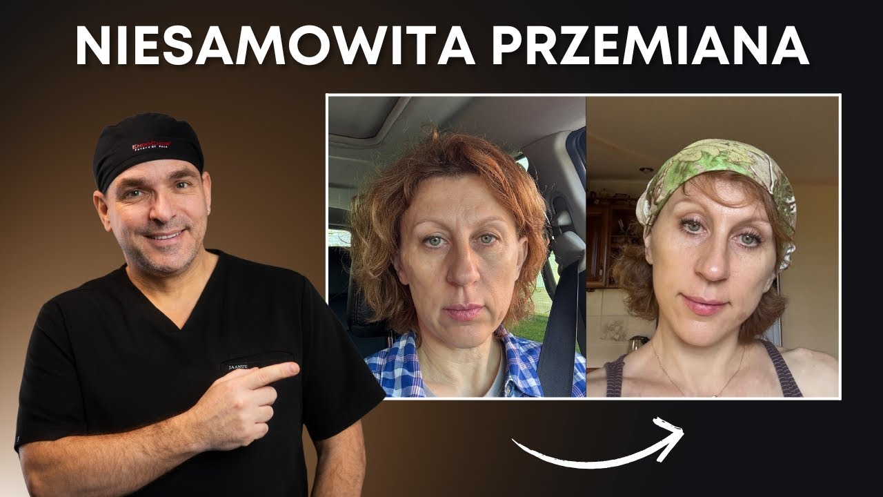 Niesamowita przemiana po liftingu twarzy | 6 miesięcy po zabiegu
