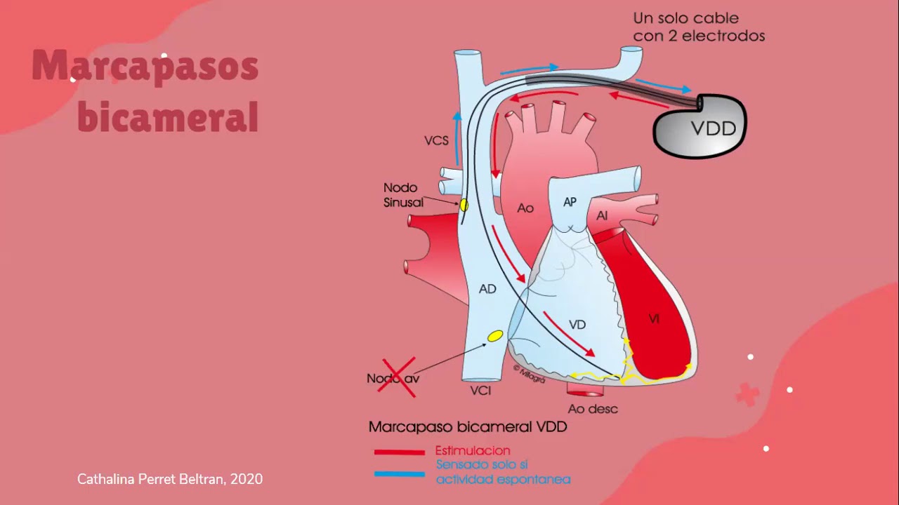 Implantes de marcapasos, cuidados y complicaciones