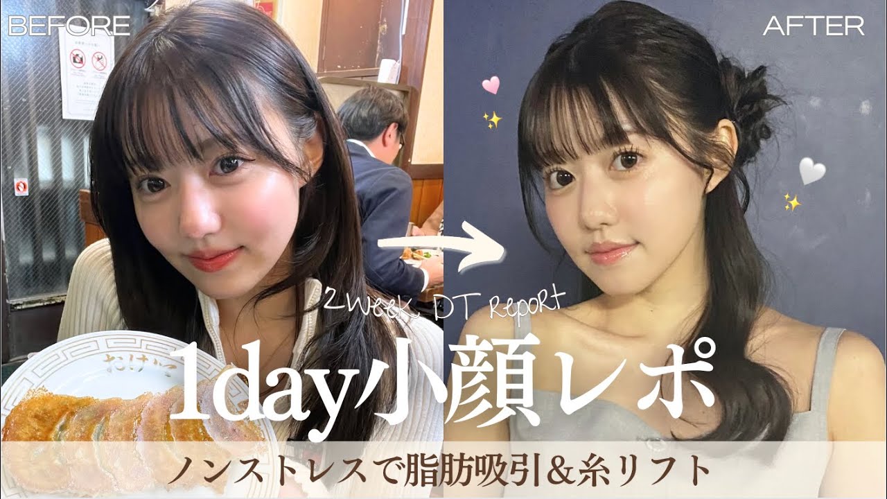 【脂肪吸引】かのちょっと変わったんだけどみんな気づいてくれたかな🥺💭餃子食べながら最近の美容とかについてお話ししていくよ🥟❕🌟