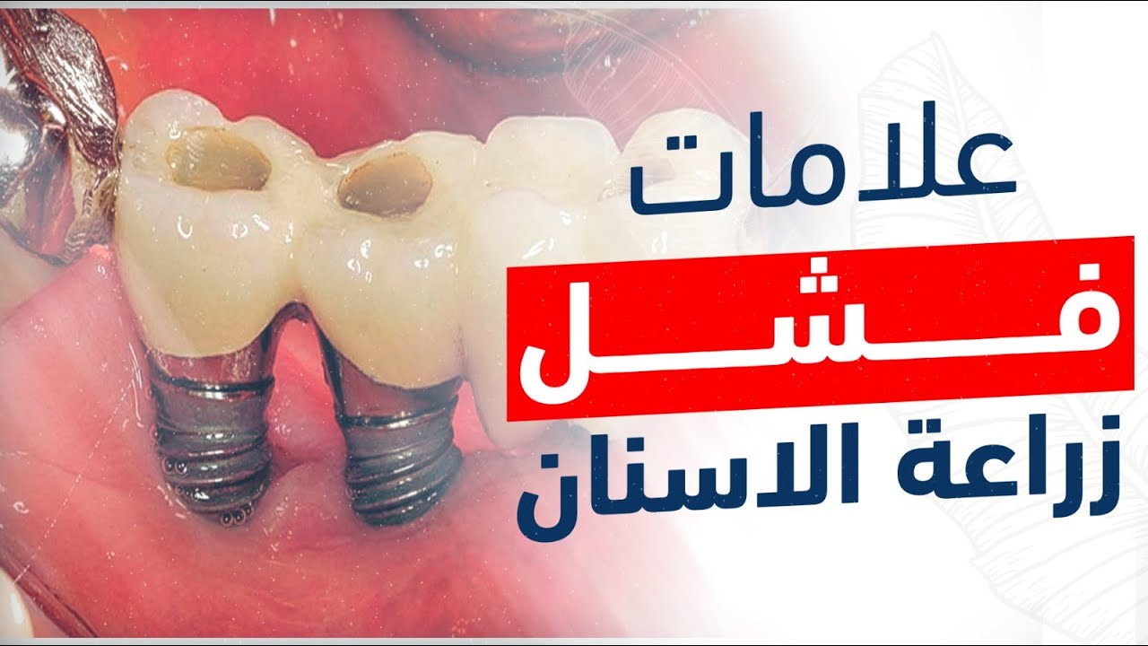 اسباب فشل زراعة الاسنان | الدكتور حمدي العوضي