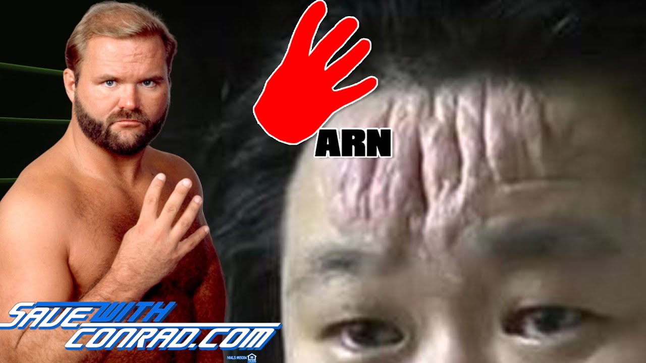 Arn Anderson on forehead scars